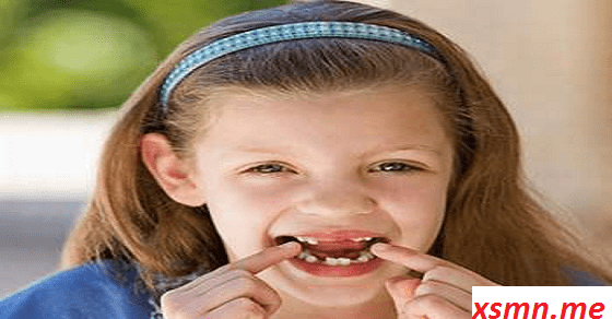 Mơ thấy nữ rụng răng